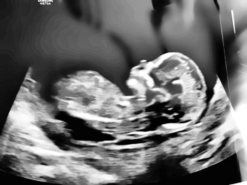 This is an ultrasound where the nub is not visible